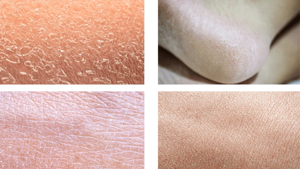 Piel corporal seca | Lo Mejor en Belleza