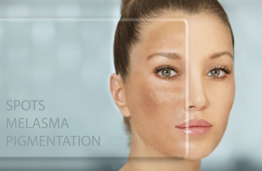 Comparación del rostro de una mujer mostrando manchas, melasma y pigmentación en un lado, y piel uniforme en el otro