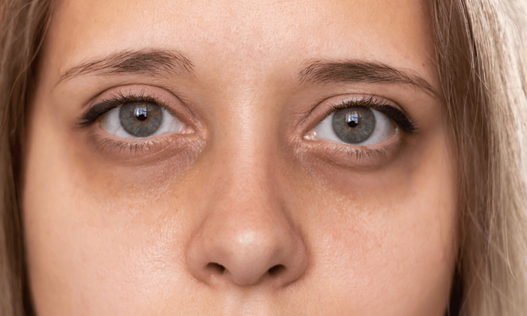 Solución ojeras y bolsas 2 Ojeras | Lo Mejor en Belleza