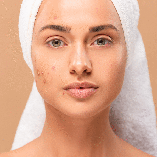 Ácido tranexámico: el activo que ayuda a reducir manchas sin irritar